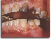All-Ceramic Crown Treatment