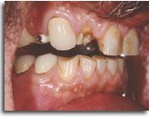 All-Ceramic Crown Treatment