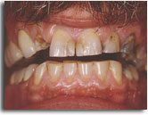 All-Ceramic Crown Treatment