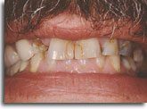 All-Ceramic Crown Treatment