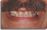 All-Ceramic Crown Treatment