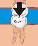 Filling Vs. Crown