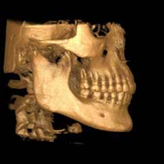 Lateral 3d image