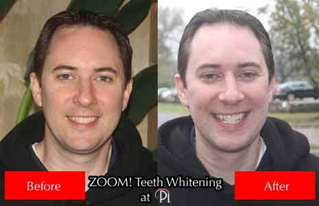 Before and After Photos Zoom Tooth Whitening