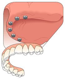 Dental Implant Treatment Solutions