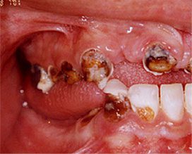 Restoration of Teeth Following Soft Drink Damage