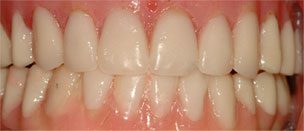 Restoration of Teeth Following Soft Drink Damage