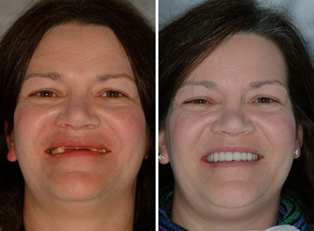 Traditional Dental Implant Treatment