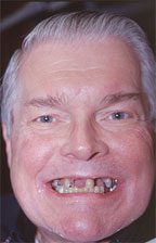 Traditional Dental Implant Photos