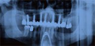 Traditional Dental Implant Photos