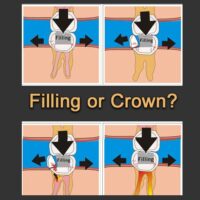 How Biting Forces Effect Teeth With Large Fillings