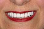 Ten reasons to choose dental implants