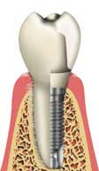 Nobel Biocare Dental Implant Supported Tooth