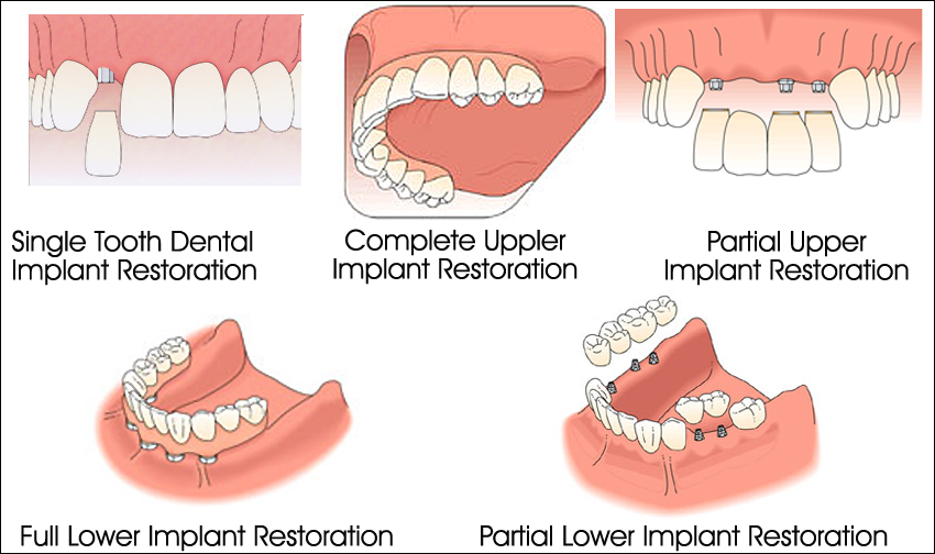Dental Implant Prosthesis Options