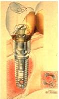 illustration of osseointegrated dental implants in bone