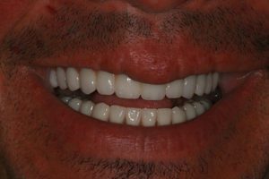 Dental Implant Makeover with AvaDent