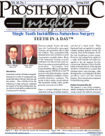 Insights Newsletter - Single Tooth Incisionless Suture-less Dental Implant Surgery2003_01_16_1-1