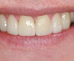 Post treatment photo following veneer placement