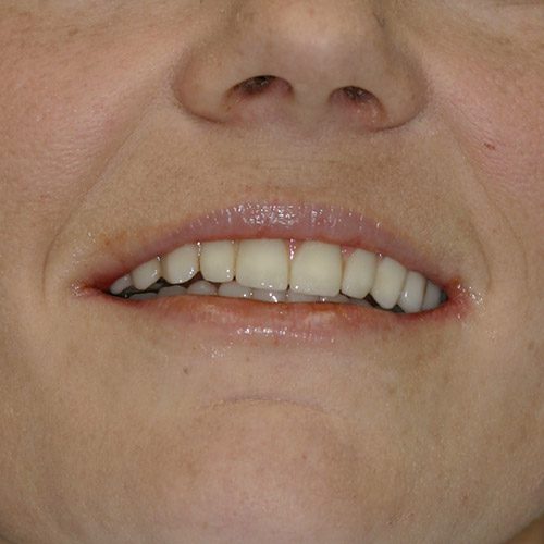 Dental Implant Treatment Relieves Tooth Pain and Preserves Bone