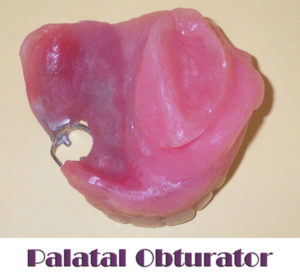 palatal obturator