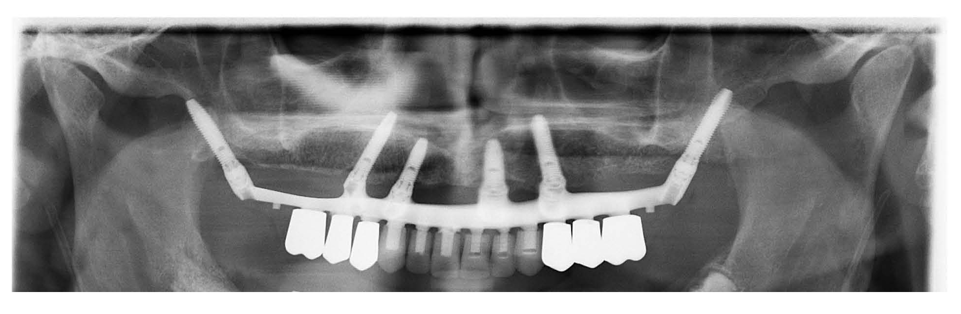 Accelerset implant supported permanent prosthesis shows how each tooth is an individual unit