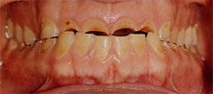 Severe tooth enamel erosion caused by soft drink consumption.