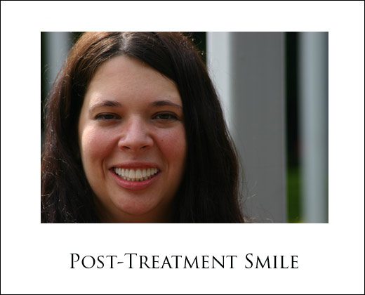 All-On-4 Dental Implant Treatment