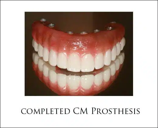 Dental Implant Prosthesis Options