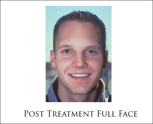 Zygomatic Dental Implant Treatment for Congenitally Missing Teeth