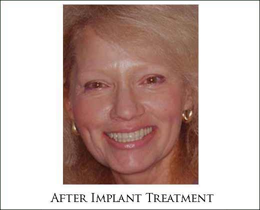 Post-treatment smile following dental implant treatment at Pi Dental Center