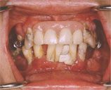 Dental Implant Patient Photo