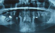 Dental Implant Patient Photo