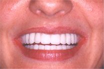 Dental Implants for Congenitally Missing Teeth