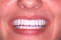 Dental Implants for Congenitally Missing Teeth