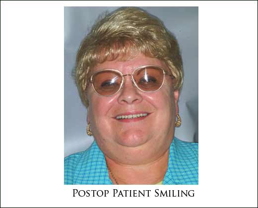 Replace Removable Dentures Permanently
