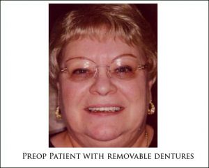 Preop Patient with removable dentures 