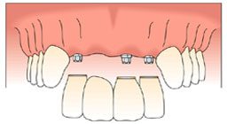 Anterior Tooth Replacement with Dental Implants