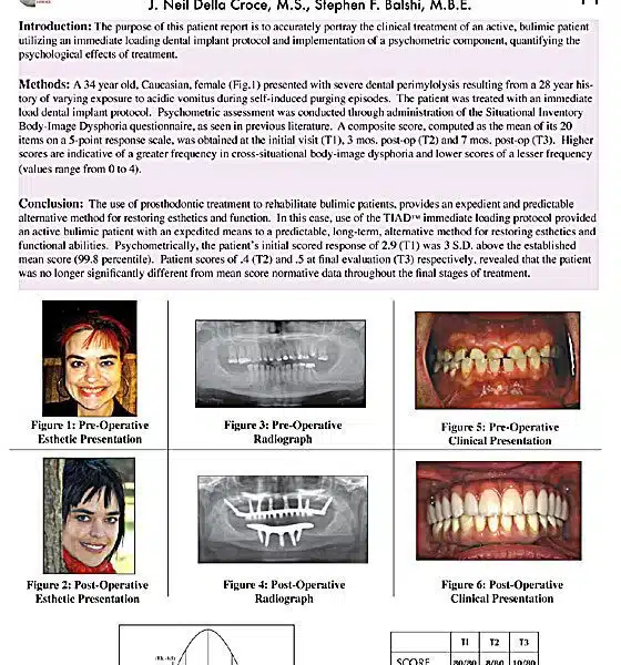 Journal Article: Full Mouth Rehab For Bulimia Patient