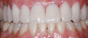 All-Ceramic Dental Crowns