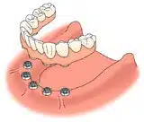 Full Lower Dental Implant Treatment