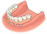 Full Lower Dental Implant Treatment
