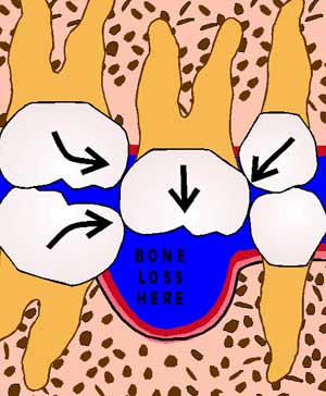 Illustration for Bone and Teeth Blog shows bone loss in lower jaw where tooth is missing
