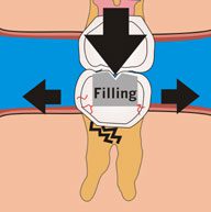 Filling Vs. Crown