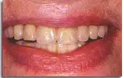 Dental Restoration