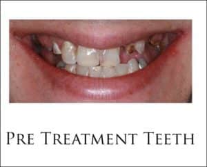 Teeth In A Day Treatment Photo