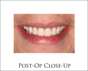 CM Prosthesis with Teeth In A Day Dental Implants