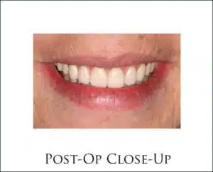 CM Prosthesis with Teeth In A Day Dental Implants