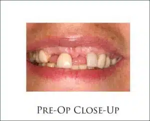 CM Prosthesis with Teeth In A Day Dental Implants