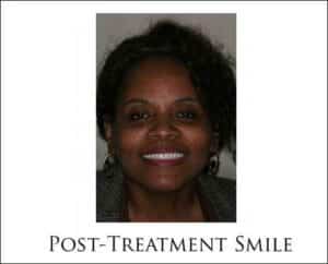 Teeth In A Day Lower Arch