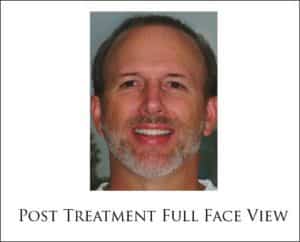 Replacing Periodontally Compromised Teeth